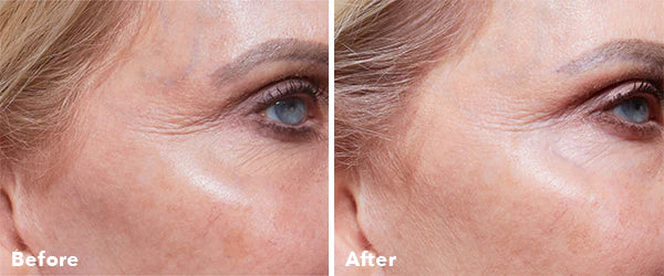 AnteAGE Home Microneedling Kit