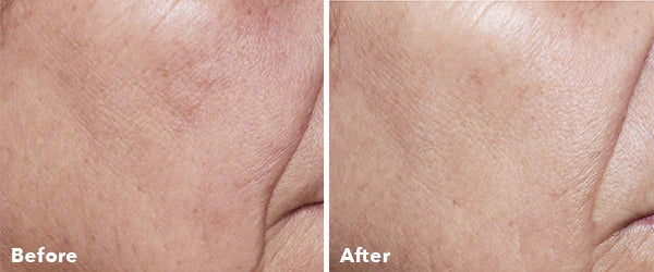 AnteAGE Home Microneedling Kit