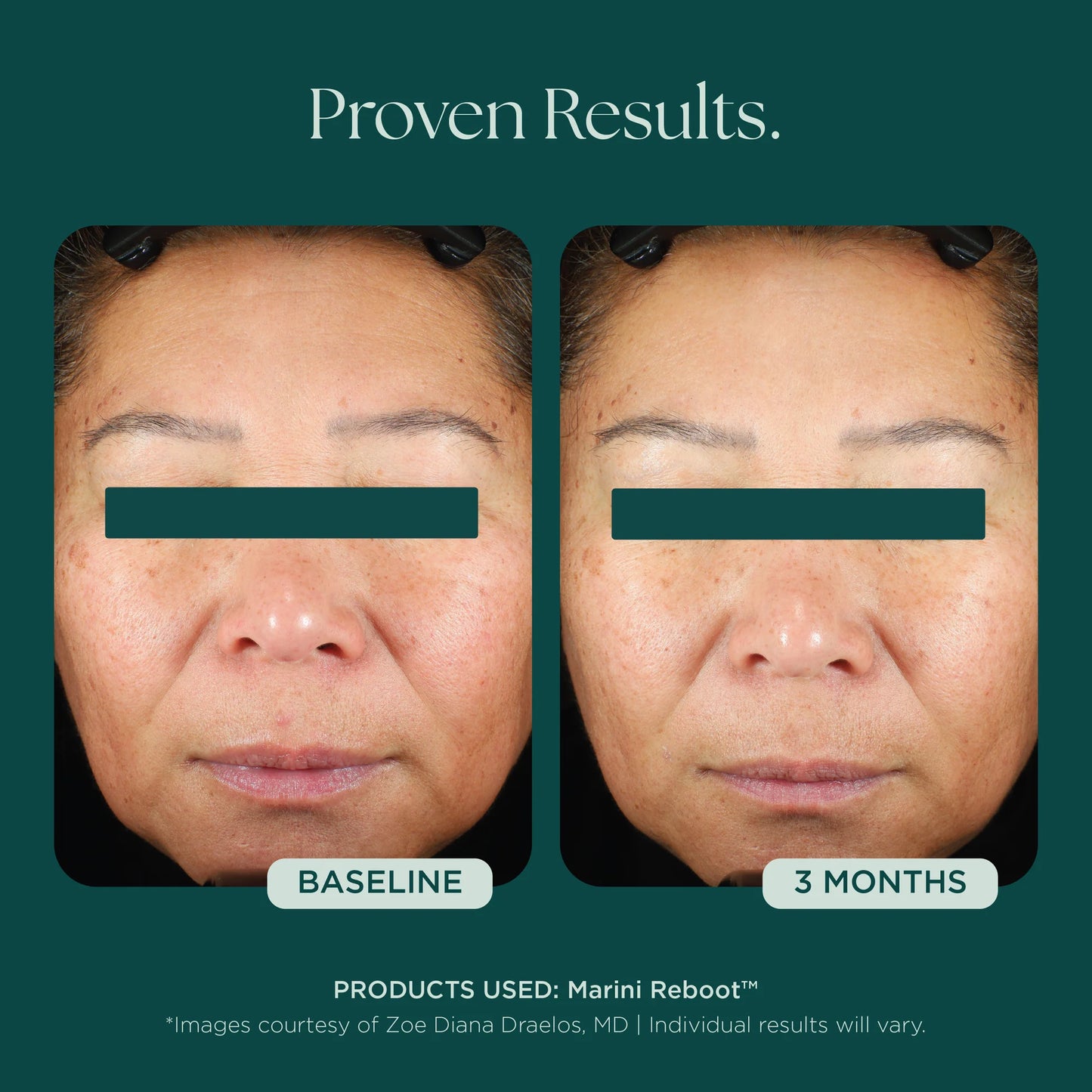 Marini Reboot™ PDRN Face Serum