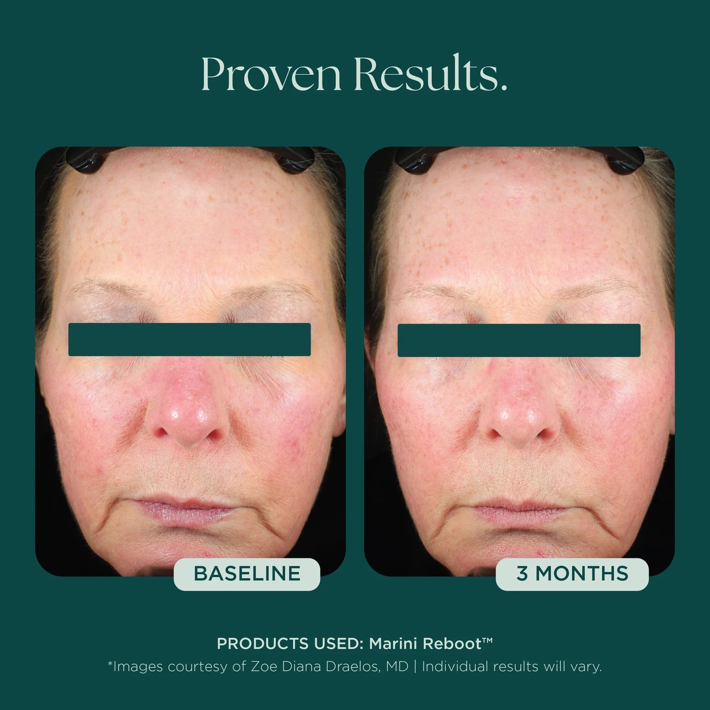Marini Reboot™ PDRN Face Serum